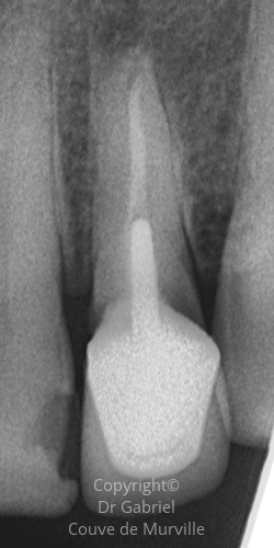 Avant une Microchirurgie Endodontique