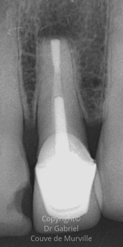 Après une Microchirurgie Endodontique