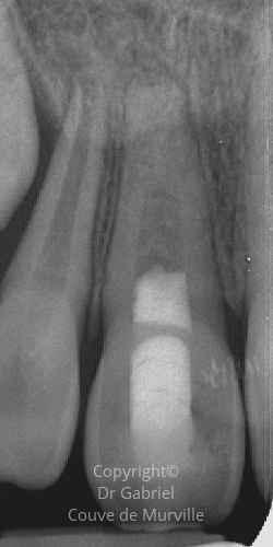 Après une Revascularisation