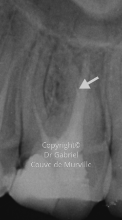 Avant un Retraitement Endodontique