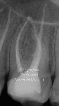 Après un Retraitement Endodontique