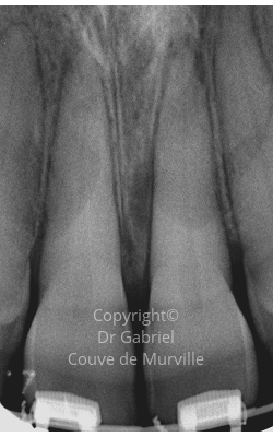 Avant un Traitement Endodontique Initial