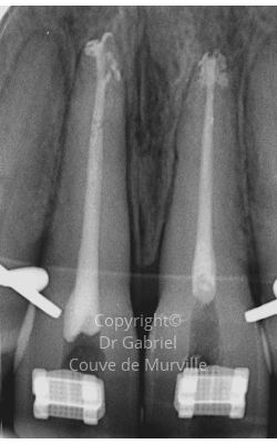 Après un Traitement Endodontique Initial